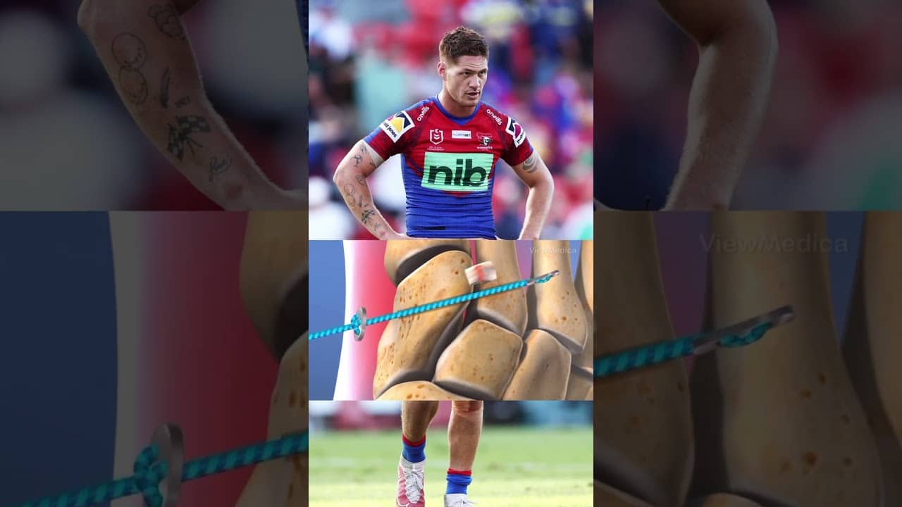 Kalyn Ponga has undergone surgery on his Lisfranc injury - season likely over #nrl