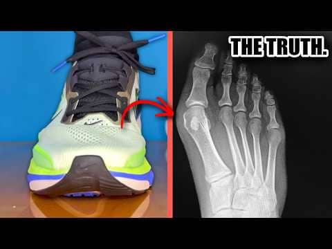 The Bizarre Truth About Tight Shoes & Bunions